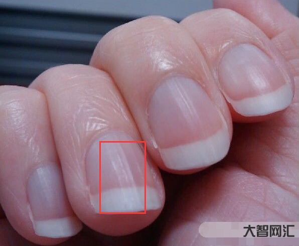 指甲有豎紋是身體的什么信號
