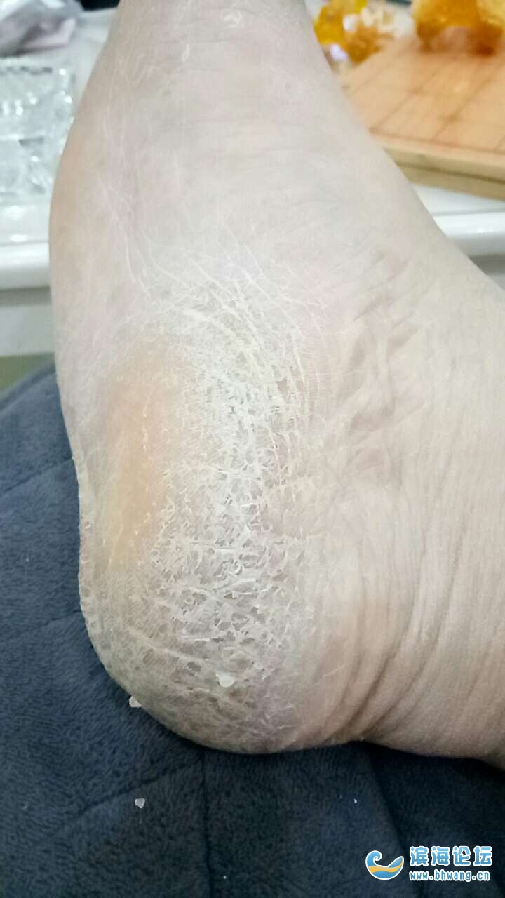 1、腳跟干裂是肝癌嗎?