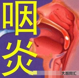 1、患咽喉炎后,身體會有什么癥狀?