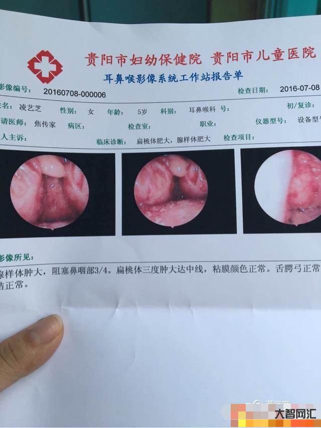 2、幾歲矯正腺樣面容是合適的