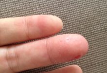 l手上起小水泡很癢怎么回事-手上長的小水泡很癢,是什么原因導致的?-大智網匯