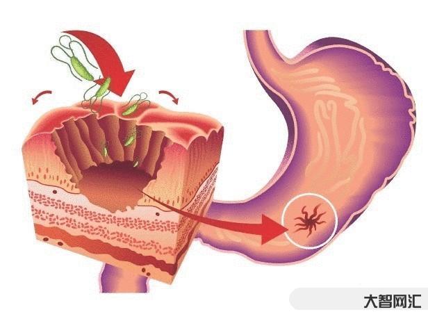 1、胃潰瘍的早期癥狀是什么？胃潰瘍的癥狀是什么？