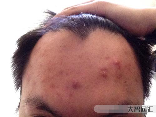 2、額頭上長(zhǎng)痘痘的原因是什么?