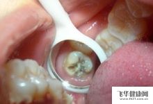 蛀牙如何讓它停止腐蝕-如何防止蛀牙惡化-大智網(wǎng)匯
