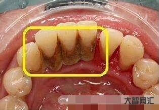 1、如何在家有效去除牙結石?