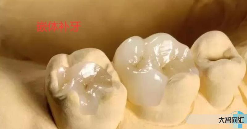 牙冠少一半怎么補(bǔ)最好呢-補(bǔ)牙,如何既省錢又省心?看這里 牙冠少一半怎么補(bǔ)最好呢-補(bǔ)牙,如何既省錢又省心?看這里