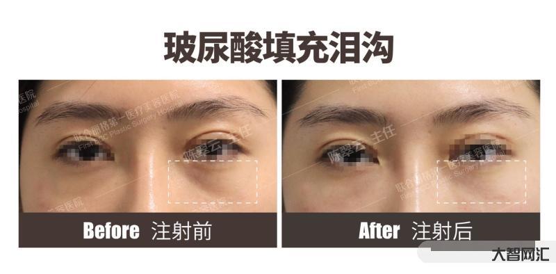 玻尿酸為什么不會溶解-真相來了|玻尿酸真如“他們”說的那般安全嗎? 玻尿酸為什么不會溶解-真相來了|玻尿酸真如“他們”說的那般安全嗎?