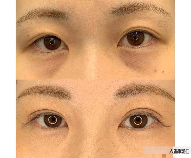 去除眼袋的方法-消除眼袋的方法有哪些呢? 去除眼袋的方法-消除眼袋的方法有哪些呢?