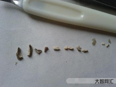 牙結石什么成分組成最多-“牙結石”可以用手摳掉嗎?教你一招,牙縫里的臟 牙結石什么成分組成最多-“牙結石”可以用手摳掉嗎?教你一招,牙縫里的臟