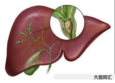2、肝內膽管結石或鈣化灶是什么意思?
