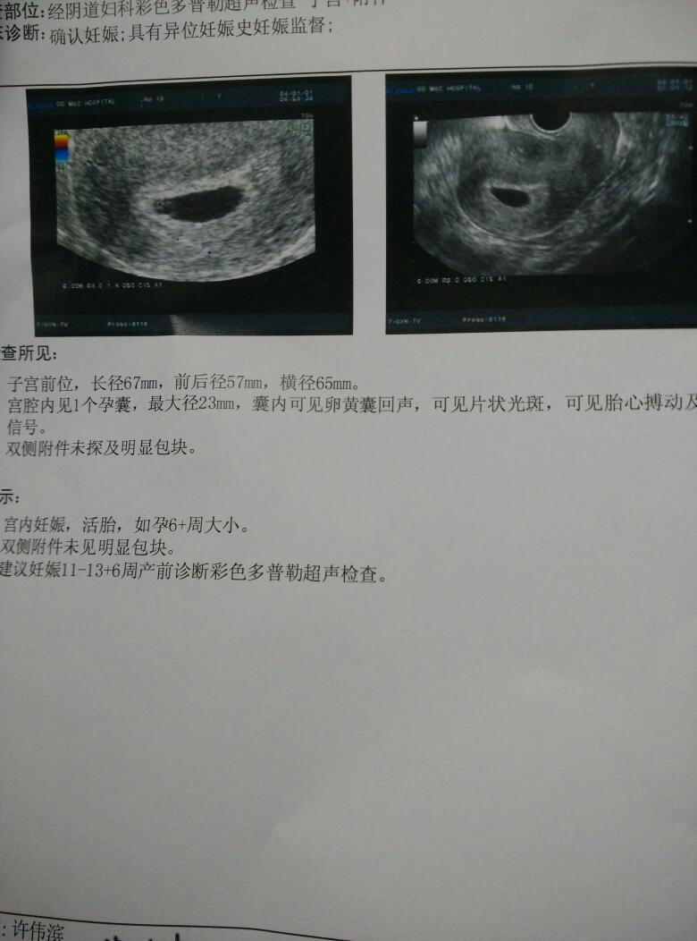 寶寶沒有動胎心正常嘛怎么辦-很多的孕媽被告知寶寶沒有胎心,往往與這些原 寶寶沒有動胎心正常嘛怎么辦-很多的孕媽被告知寶寶沒有胎心,往往與這些原