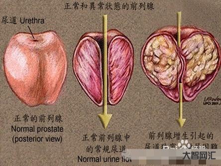 38歲前列腺有增生怎么辦-中老年人得了前列腺增生怎么辦?不用慌,3大治 38歲前列腺有增生怎么辦-中老年人得了前列腺增生怎么辦?不用慌,3大治