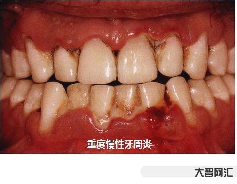 牙齒間歇性串著疼痛-莫名其妙的牙痛是病嗎? 牙齒間歇性串著疼痛-莫名其妙的牙痛是病嗎?
