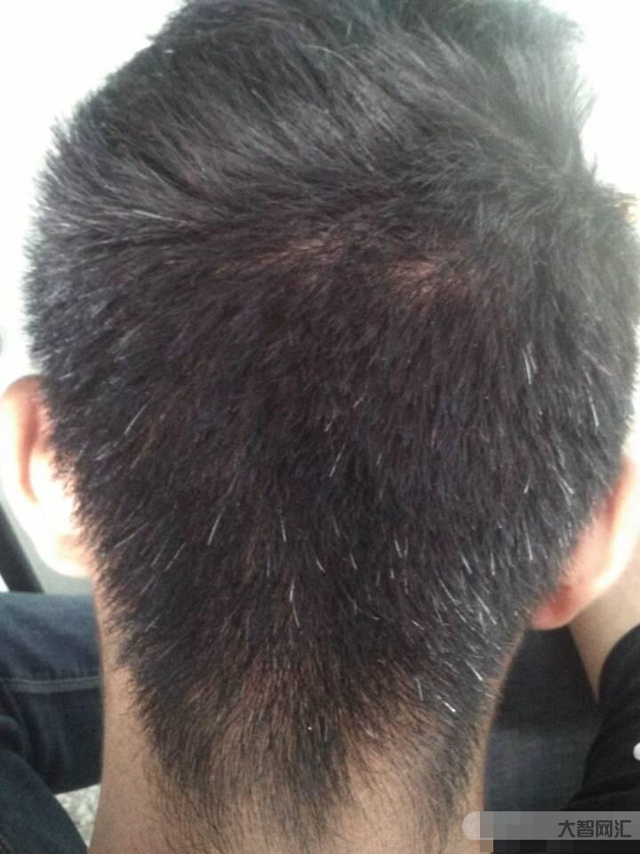 年輕人白發是血熱嗎-長白頭發是缺什么維生素導致的?醫學專家詳細分析，讓