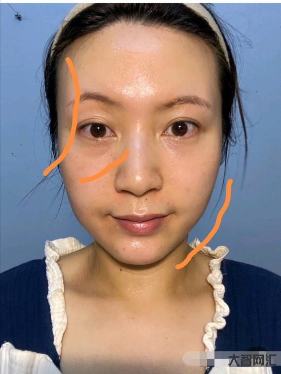 下巴上突然有凹陷-面中部凹陷、下巴很長(zhǎng)，像朱元璋這種“豬腰子臉”還能拯