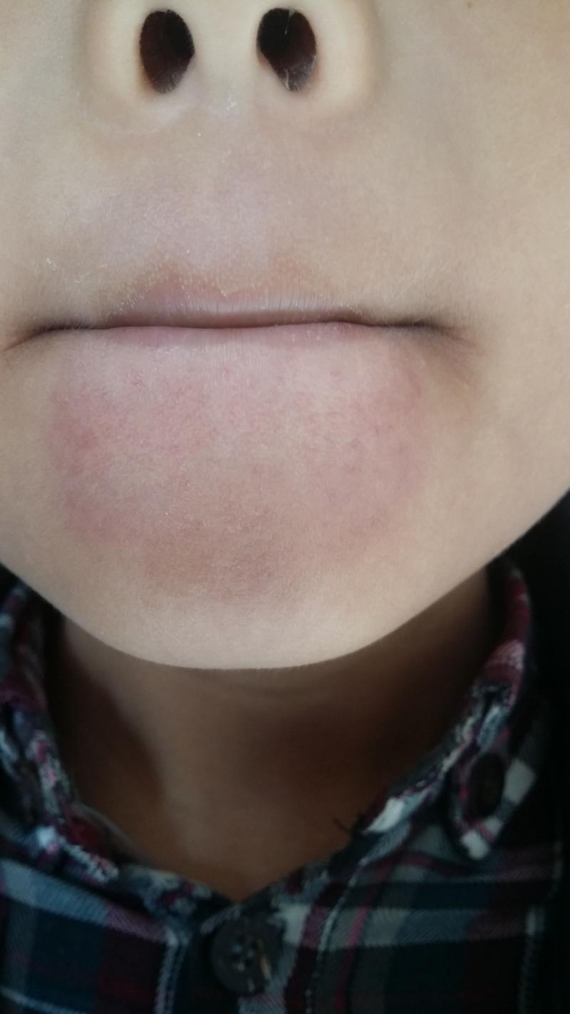 下巴上突然有凹陷-面中部凹陷、下巴很長(zhǎng)，像朱元璋這種“豬腰子臉”還能拯