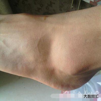 腳踝扭傷了腫了怎么恢復最快-踝關節負重大易扭傷,踝關節扭傷后采取“6步 腳踝扭傷了腫了怎么恢復最快-踝關節負重大易扭傷,踝關節扭傷后采取“6步