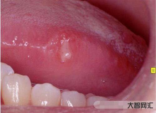 舌頭上潰瘍怎么治-有一種劇痛叫“口腔潰瘍”,補充維C不管用,3種方法更 舌頭上潰瘍怎么治-有一種劇痛叫“口腔潰瘍”,補充維C不管用,3種方法更