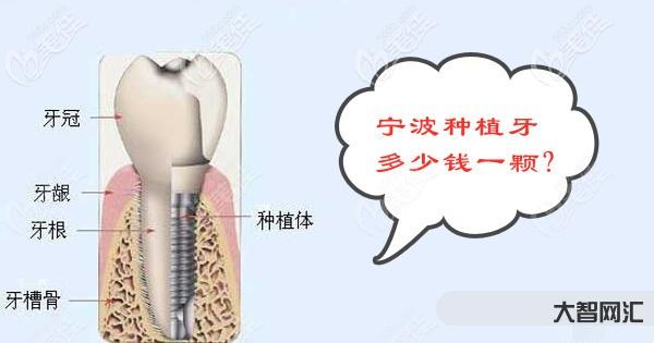 種植牙多少錢一顆-多地開始實(shí)施“種牙價(jià)格調(diào)控”,最新價(jià)格→ 種植牙多少錢一顆-多地開始實(shí)施“種牙價(jià)格調(diào)控”,最新價(jià)格→