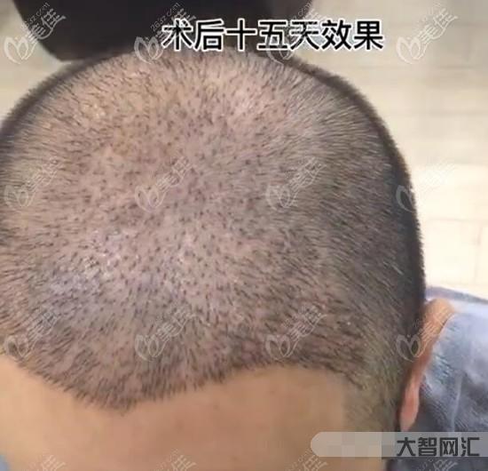 植發(fā)5000個(gè)毛囊多少錢-人均2.8萬(wàn)!看到植發(fā)價(jià)格單，頭更“涼”了