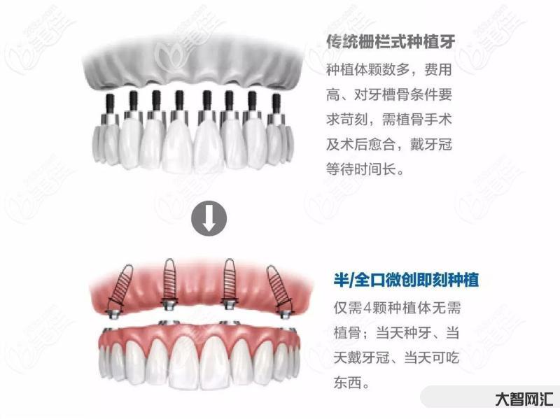 種牙多少錢一顆啊-集采落地后種牙怎么選?種一顆牙便宜多少錢?