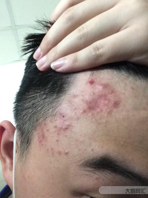 額頭長(zhǎng)痘痘怎么快速去除-快速消除額頭痘痘方法 額頭長(zhǎng)痘痘怎么快速去除-快速消除額頭痘痘方法
