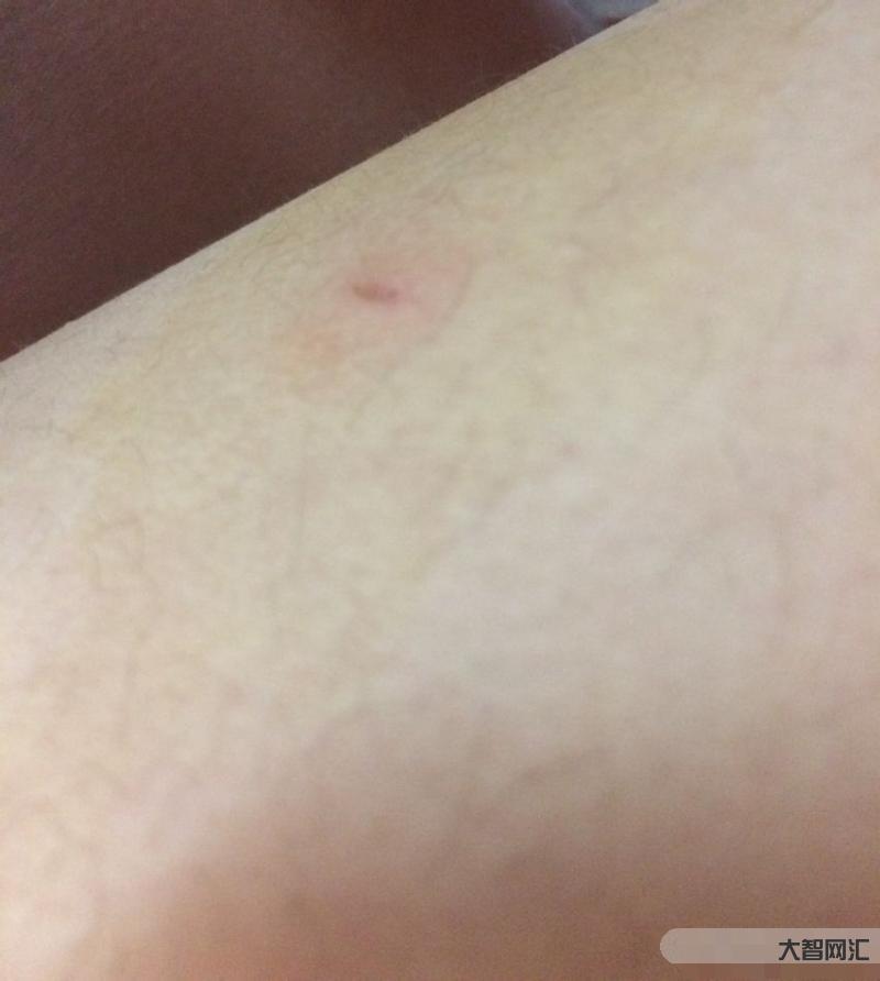 被貓抓了一下輕微破皮要打針嗎-被自己養的貓咪抓傷了、破皮了，該怎么處理