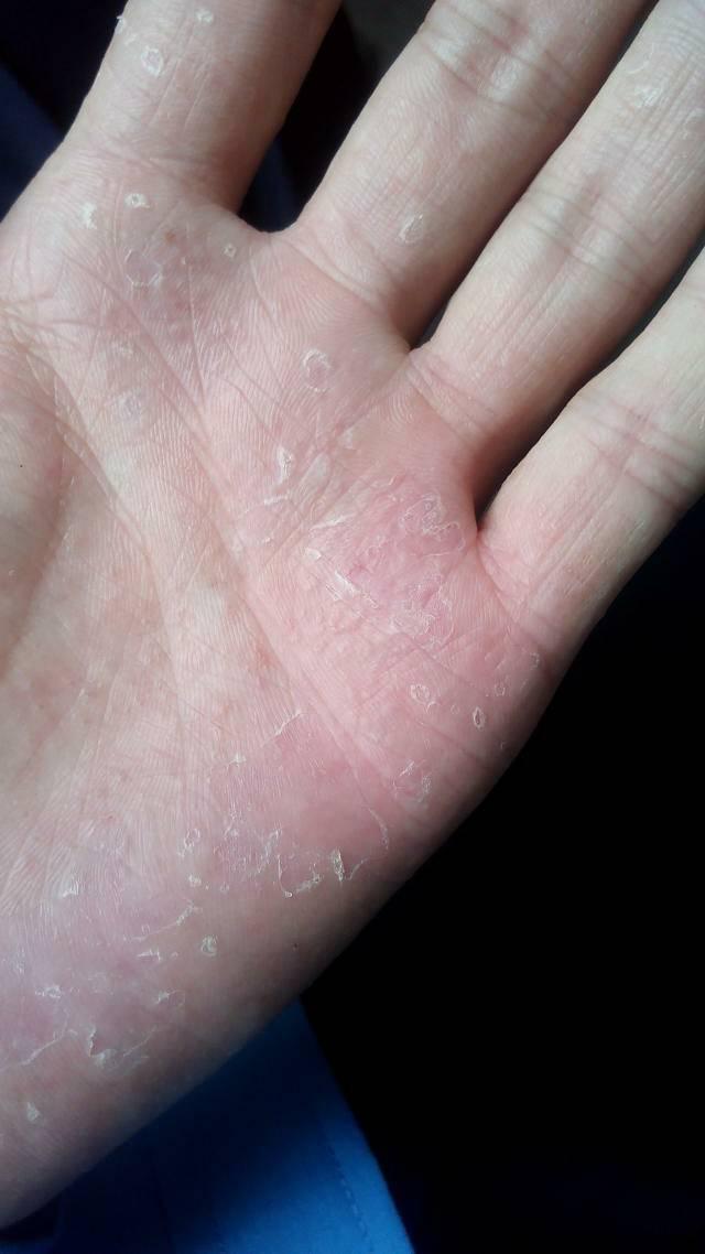 手脫皮是什么原因?qū)е碌?手脫皮是怎么回事?通常是缺乏這種維生素，補(bǔ)一補(bǔ)