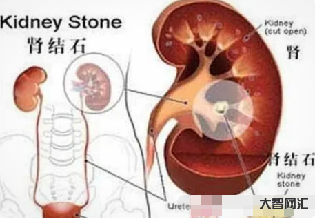 腎結石的癥狀有哪些癥狀-腎結石有哪些癥狀 腎結石的癥狀有哪些癥狀-腎結石有哪些癥狀