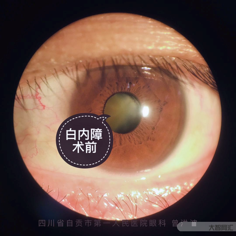 白內障的主要癥狀是什么-白內障患者的常見癥狀表現 白內障的主要癥狀是什么-白內障患者的常見癥狀表現