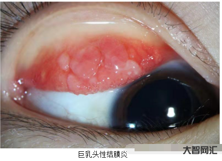 結膜炎有哪些癥狀-結膜炎的癥狀都有哪些 注意用眼衛生預防結膜炎 結膜炎有哪些癥狀-結膜炎的癥狀都有哪些 注意用眼衛生預防結膜炎