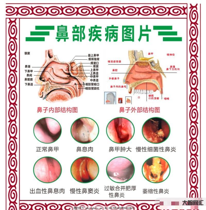 鼻炎的癥狀都有哪些-鼻炎癥狀及日常護理 鼻炎的癥狀都有哪些-鼻炎癥狀及日常護理