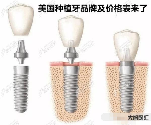 種植牙多少錢一顆2023年-種植牙降價啦!說說種植牙價格那些事 種植牙多少錢一顆2023年-種植牙降價啦!說說種植牙價格那些事