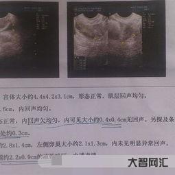 盆腔積液的原因，盆腔積液是炎癥嗎