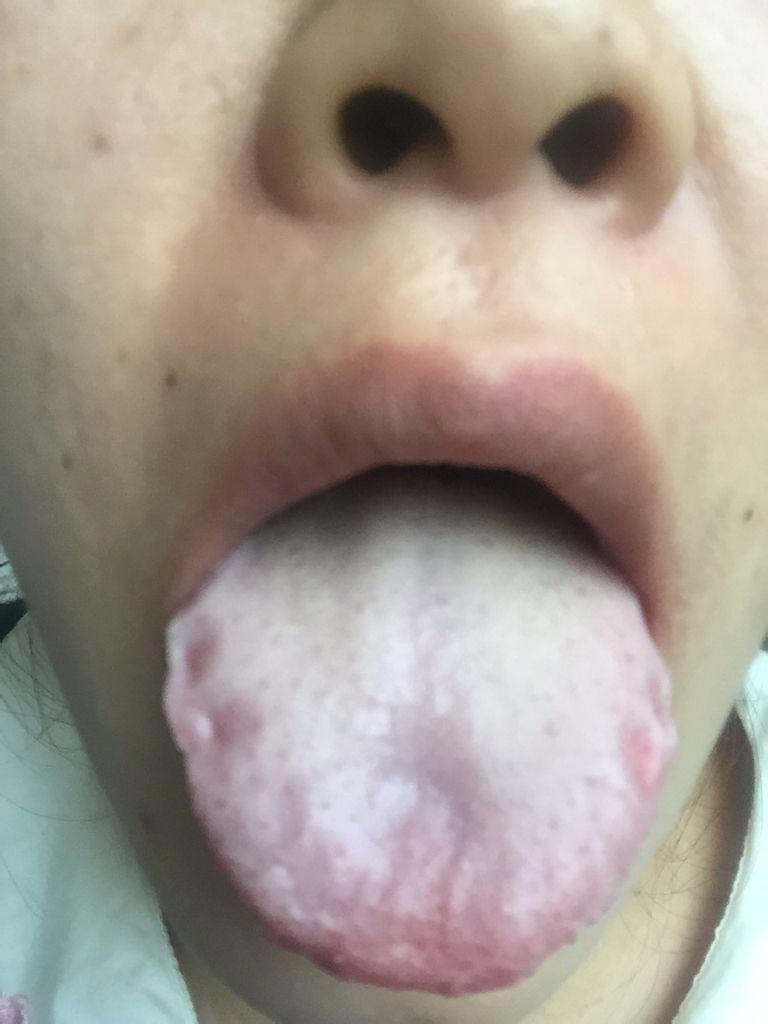 舌苔發黃厚膩是什么原因怎么調理-舌苔發黃、厚膩,要不要刮了它?看完你就 舌苔發黃厚膩是什么原因怎么調理-舌苔發黃、厚膩,要不要刮了它?看完你就