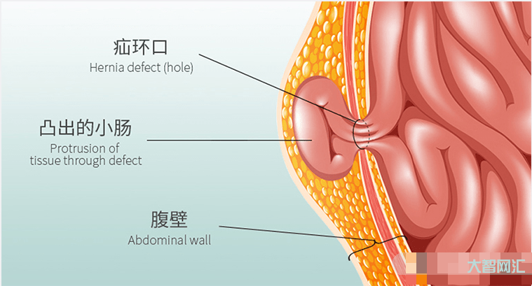 疝氣是怎么回事-勿以“疝”小而不為!肚子上有了這種“鼓包”趕緊治 疝氣是怎么回事-勿以“疝”小而不為!肚子上有了這種“鼓包”趕緊治