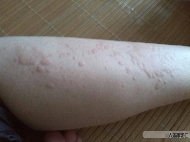 蕁麻疹是怎么引起的原因造成的-蕁麻疹是因為吃海鮮所引起?除了食物,它們 蕁麻疹是怎么引起的原因造成的-蕁麻疹是因為吃海鮮所引起?除了食物,它們