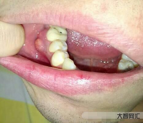 牙齦發(fā)炎腫痛怎么消炎最快-牙齦腫痛，吃什么藥最管用?