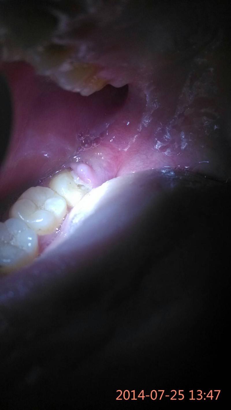 智齒牙齦發炎腫痛怎么辦-拔智齒解決牙齦腫痛問題 智齒牙齦發炎腫痛怎么辦-拔智齒解決牙齦腫痛問題