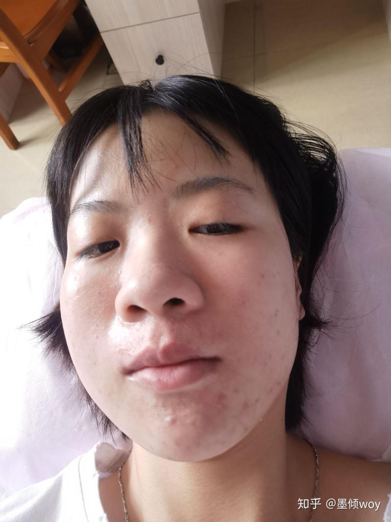 怎么樣去痘-痘痘總是反復無常?改掉這些祛痘誤區,8個實戰妙招告別痘痘臉 怎么樣去痘-痘痘總是反復無常?改掉這些祛痘誤區,8個實戰妙招告別痘痘臉